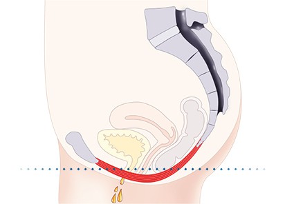 Pelvic-Floor Muscle Repair 5 Pelvic floor muscles Northolt